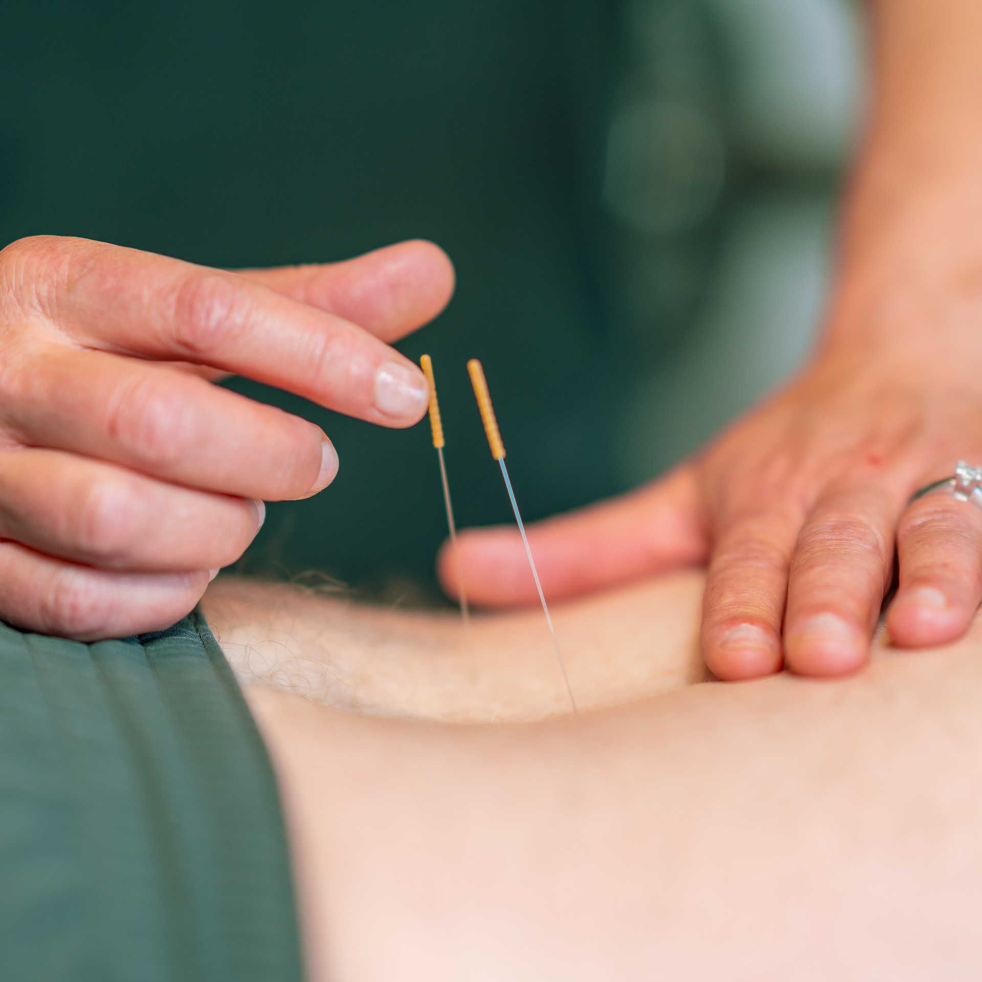 121 Physical Therapy Clarkston, Michigan Dry Needling Therapy